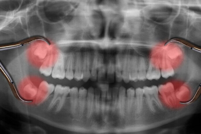 The Complete Guide To Safe Wisdom Teeth Removal By A Dentist In Maple Ridge